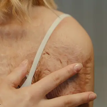 Hair Transplant
